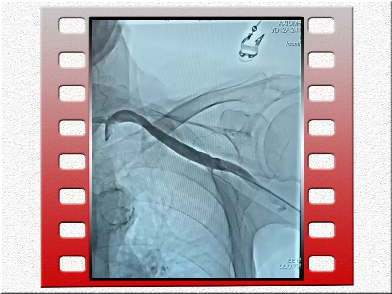 Sincan'da Tıp Dünyasında İlklere İmza Atıldı: Damarı Tıkalı Hastada Özgün Yöntemle Başarılı TAVI İşlemi