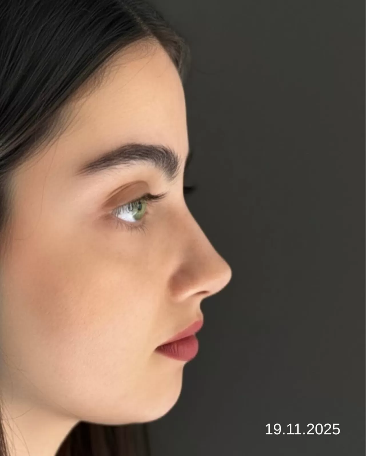 Burun Estetiği Sonrası 4 Aylık İyileşme Süreci Tamamlandı