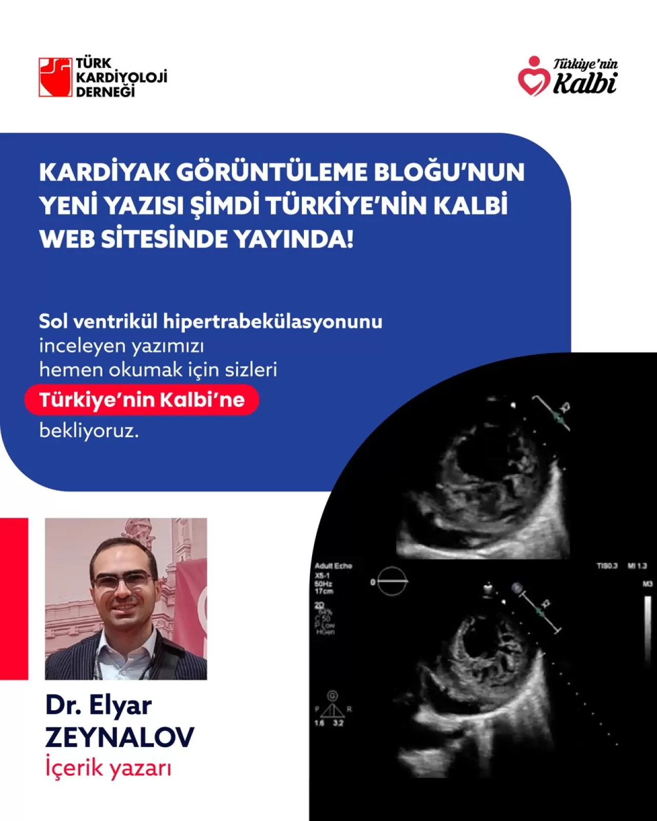 Sol Ventrikül Hipertrabekülasyonu: Tanım ve Uzman Erişim Bilgileri