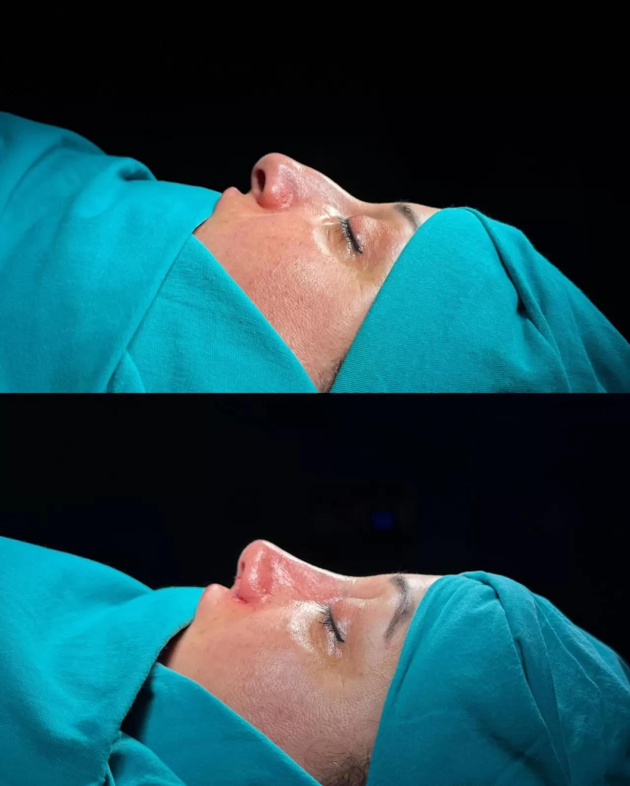 Ankara'da Profesyonel Rinoplasti Operasyonu Başarıyla Gerçekleştirildi