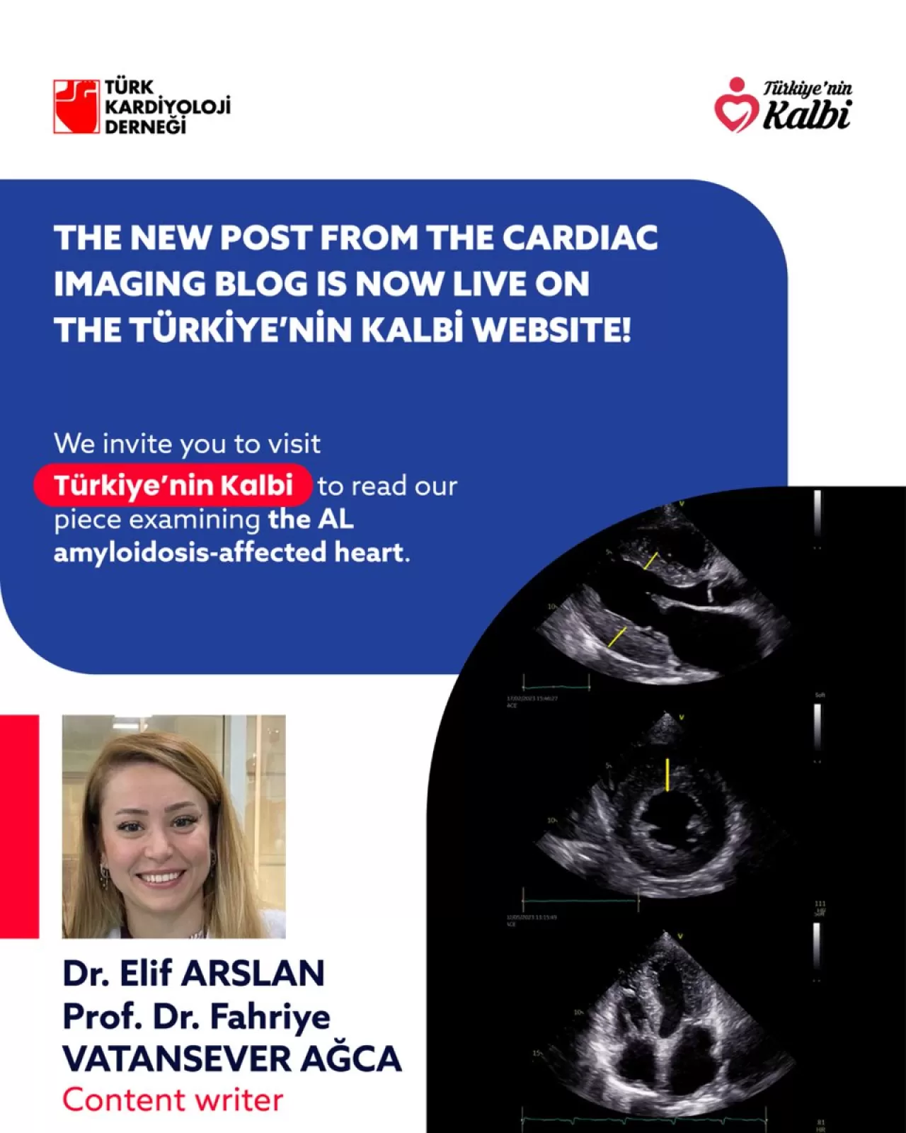 Türk Kardiyoloji Derneği'nden AL Amiloidozu ile İlgili Uzmanlara Yönelik Önemli Kaynak