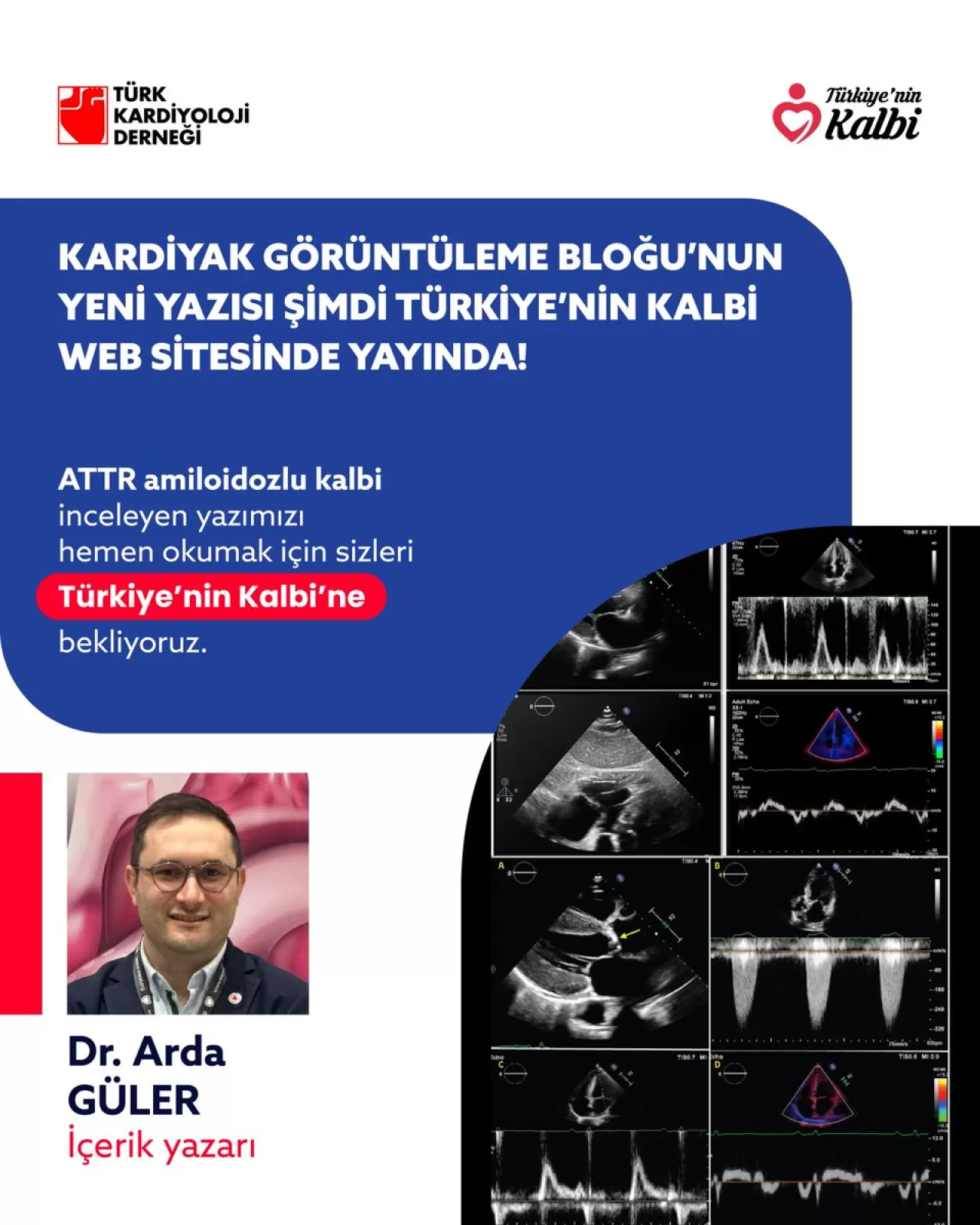 Türk Kardiyoloji Derneği, ATTR Amiloidozlu Kalp Konusunda Uzmanlara Yönelik Yazıyı Yayınladı