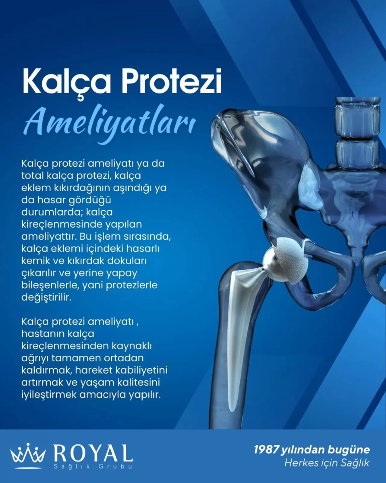 Kalça Protezi Ameliyatı ile Yaşam Kalitenizi Artırın