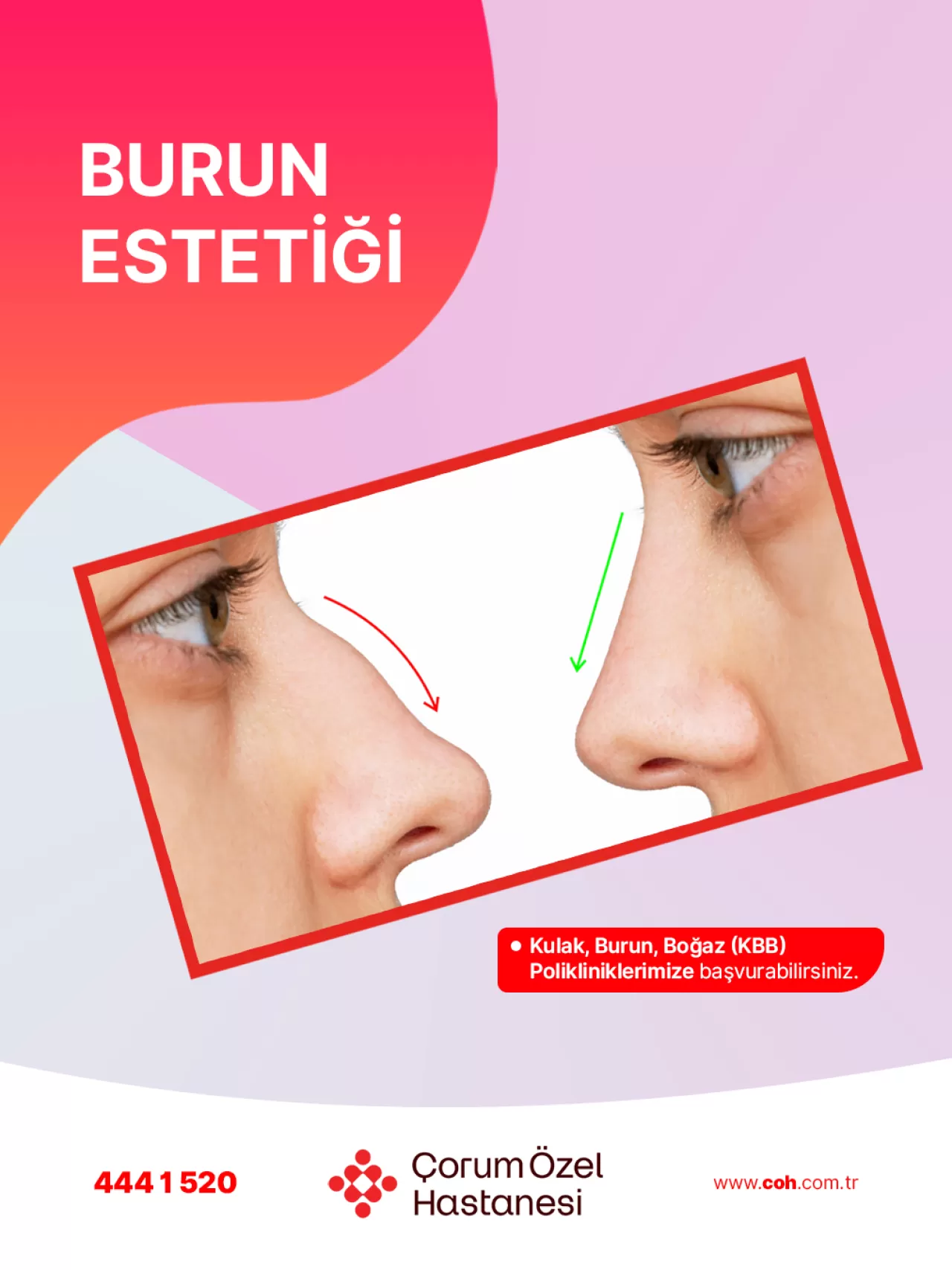 Çorum Özel Hastanesi'nde Burun Estetiğinde Çığır Açan Ultrasonik Piezo Yöntemi