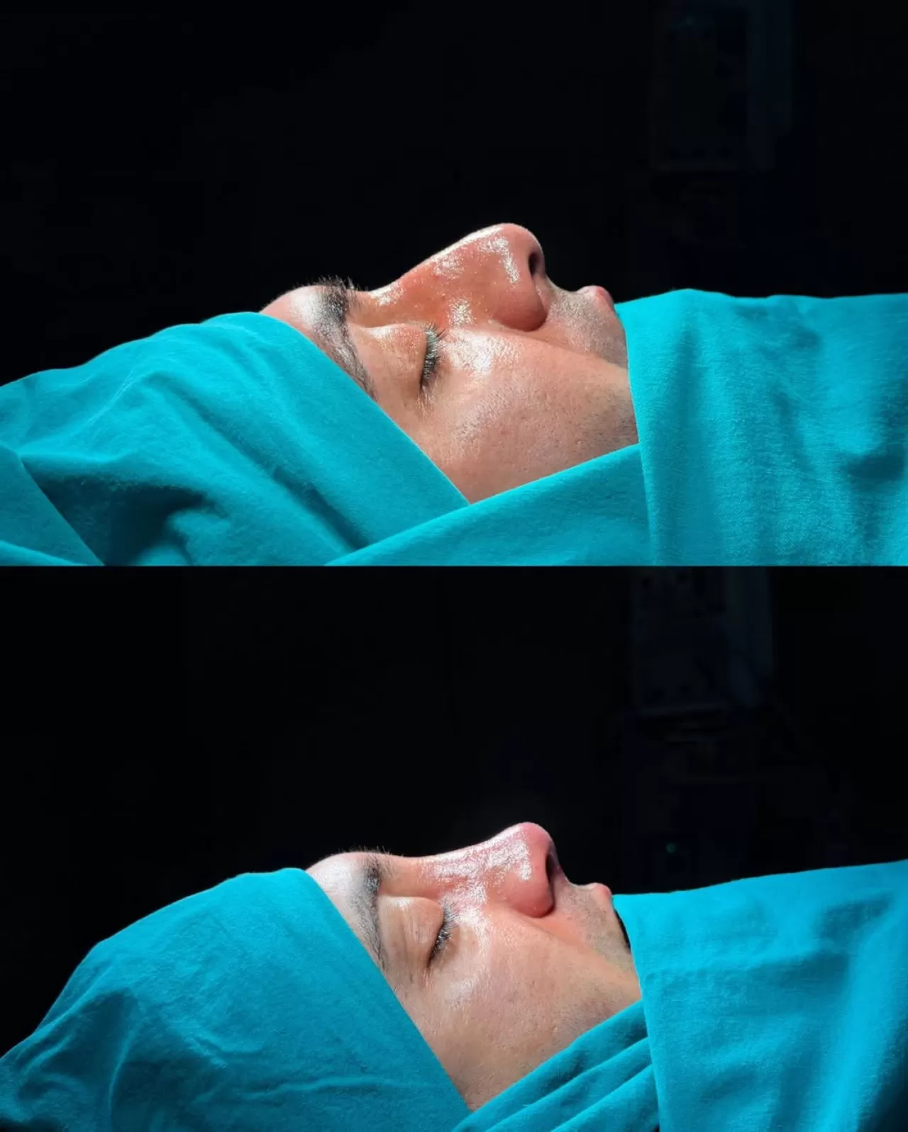 Ankara'da Gerçekleştirilen Başarılı Rinoplasti Ameliyatı