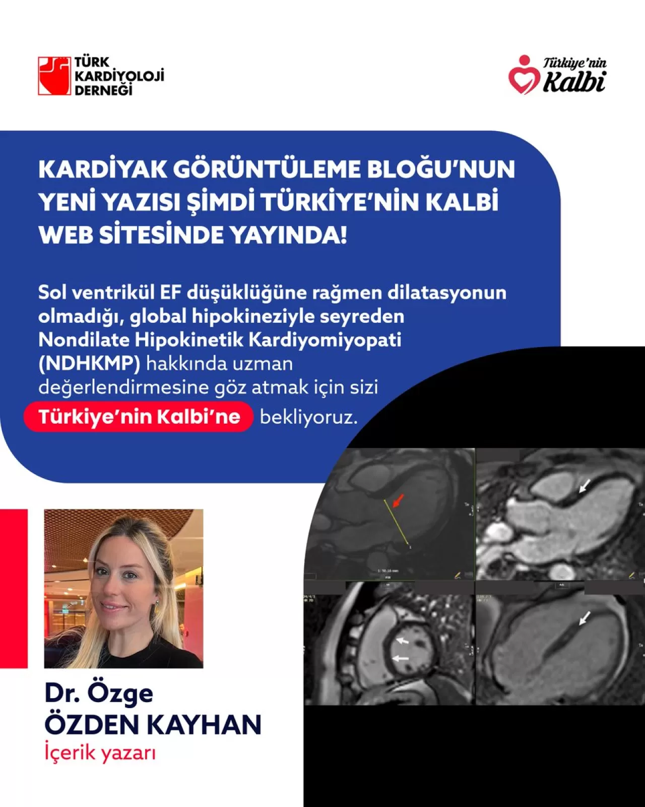 Uzmanlar Nondilate Hipokinetik Kardiyomiyopati'yi Değerlendiriyor