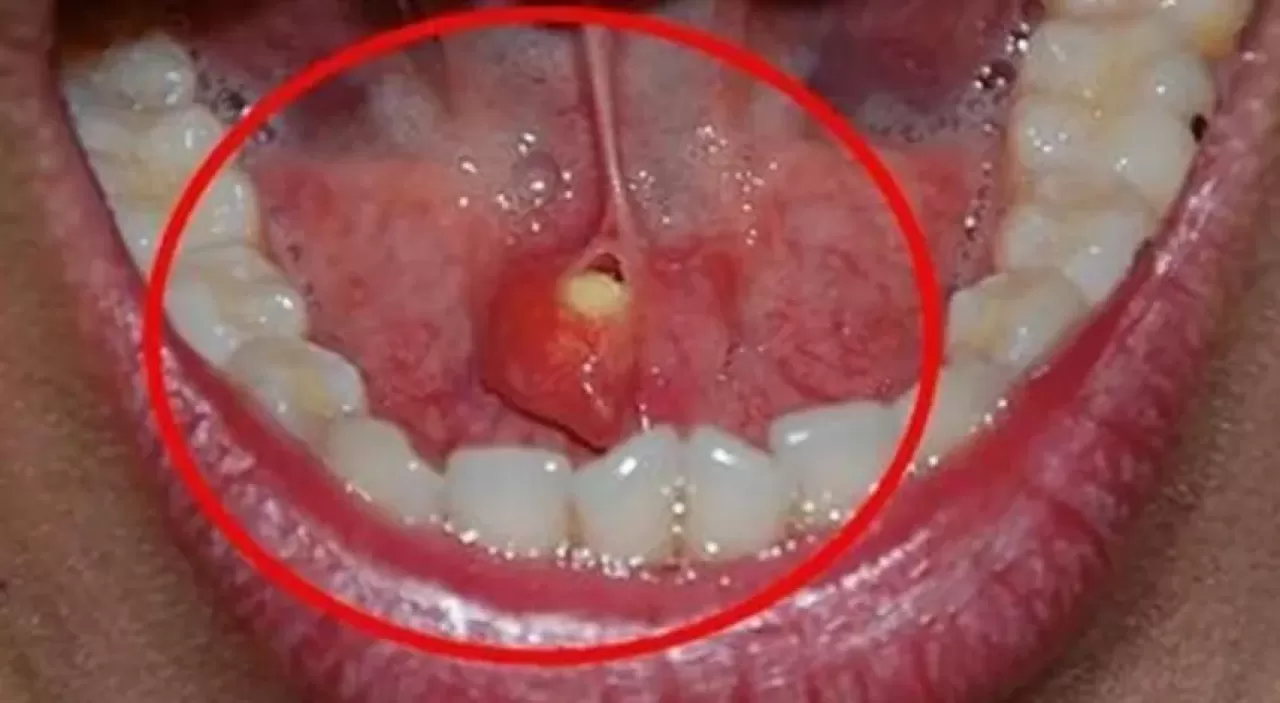 Kronik Ağız Kuruluğunun Sessiz İşaretleri: Günlük Yaşamda Gözden Kaçan Belirtiler