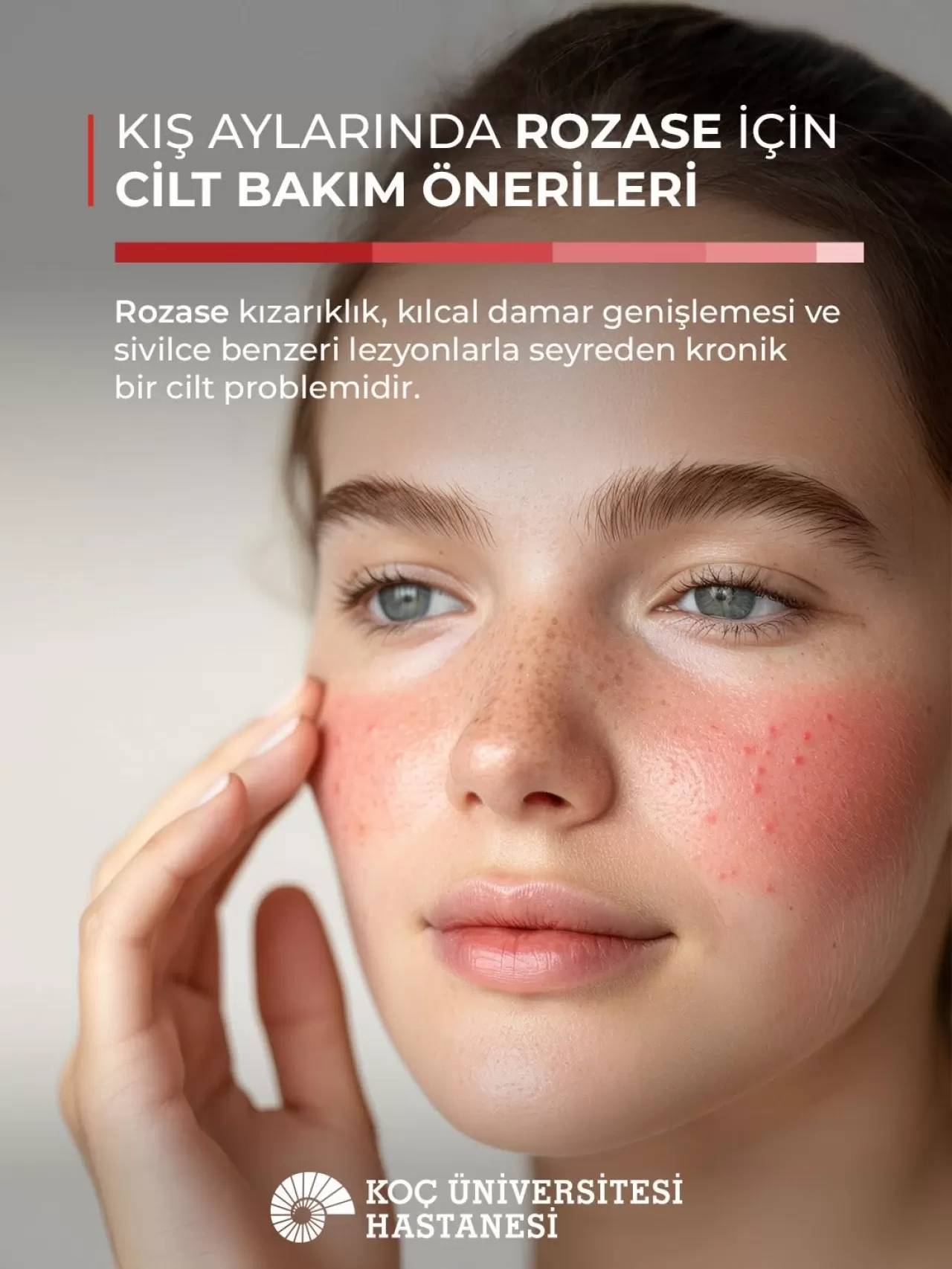 Kış Aylarında Rozase (Gül Hastalığı) Alevlenmelerine Dikkat