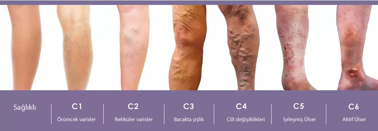 Bacaklardaki Ağırlık Hissi ve Gece Krampları Venöz Yetmezliğin Sessiz İşareti Olabilir