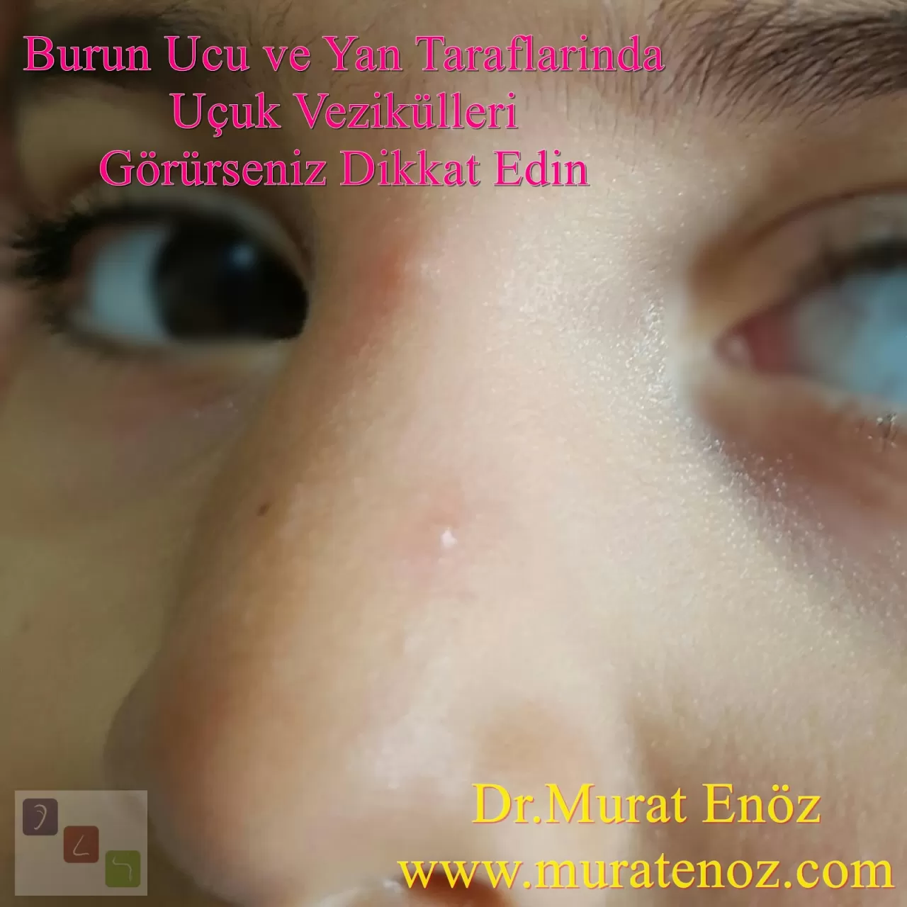 Kronik Burun Kaşıntısı, Trigeminal Sinir İrritasyonunun İşareti Olabilir