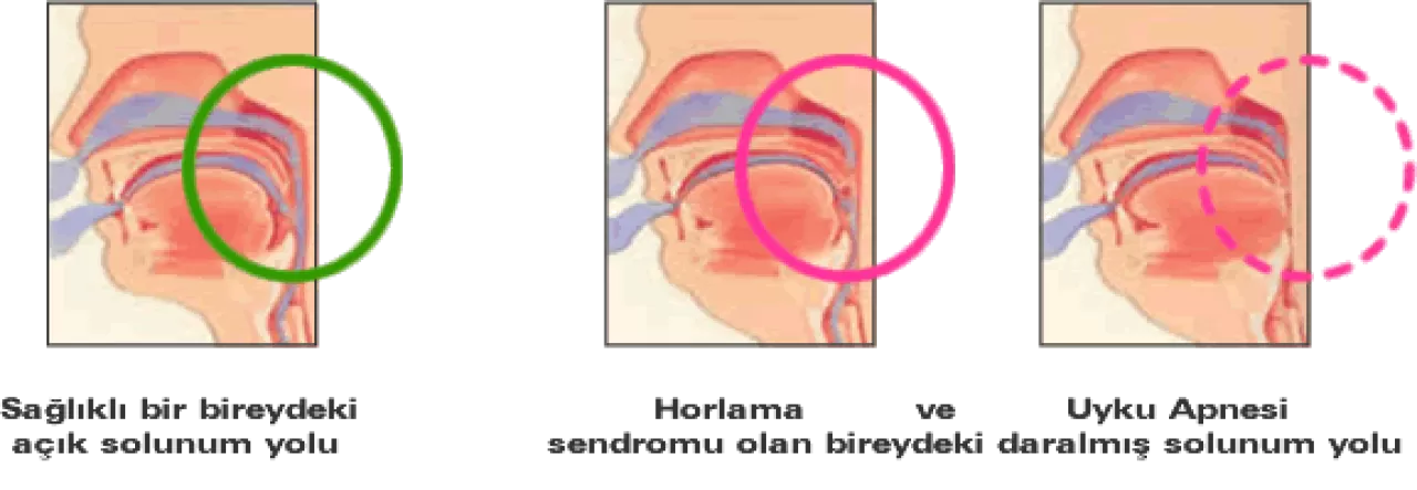 Horlama Sadece Bir Ses Değil: Gün İçindeki Bu Belirtilere Dikkat!