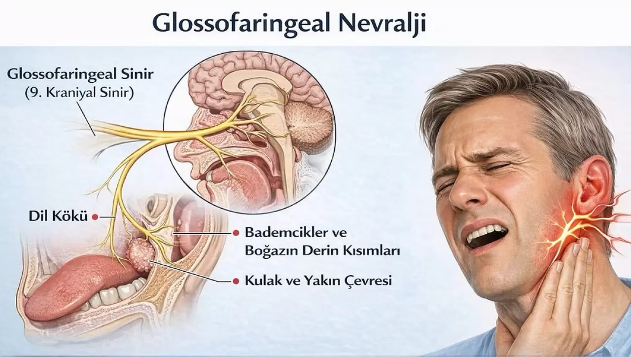 Glossofaringeal Nevralji: Şiddetli Boğaz ve Dil Ağrısının Nadir Nedeni