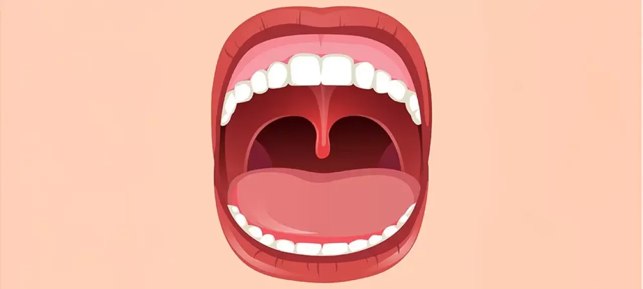 Kronik Üvülit: Boğazda Takılma Hissi ve Ses Kısıklığının Gizli Nedeni Olabilir