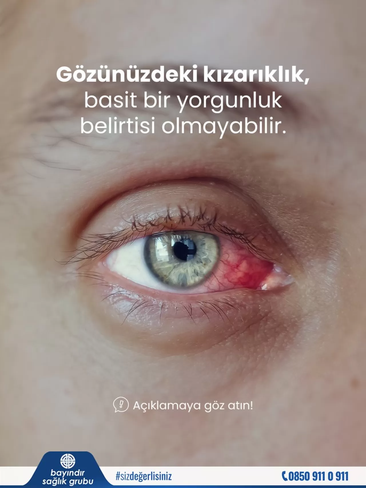 Göz Kanlanması Ne Zaman Tehlikeli? İşte Dikkat Edilmesi Gereken Belirtiler