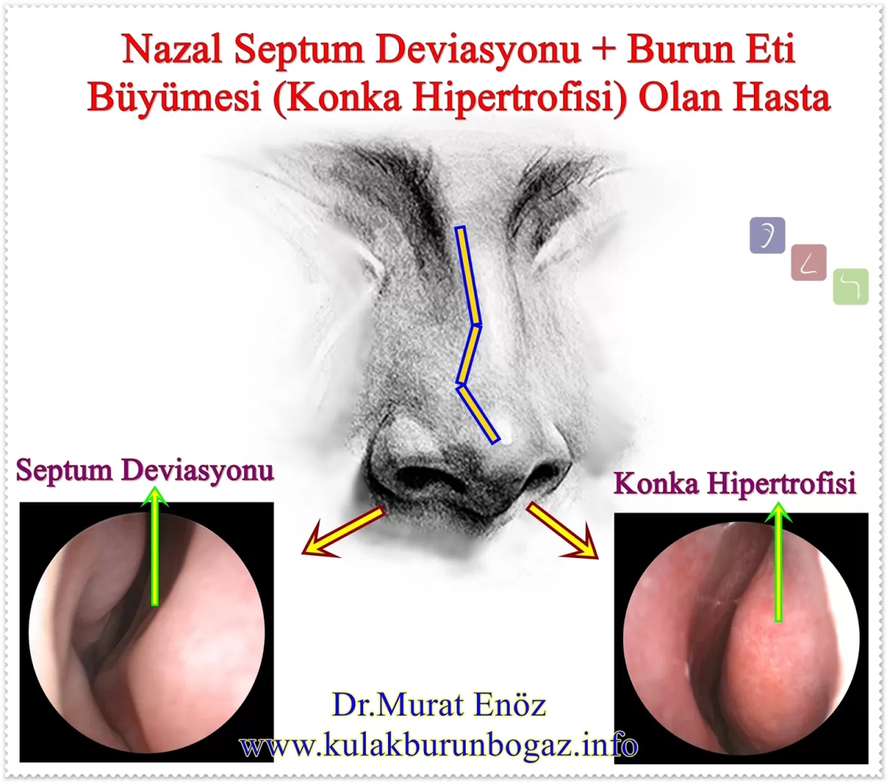 Kronik Burun Tıkanıklığının Arkasındaki 