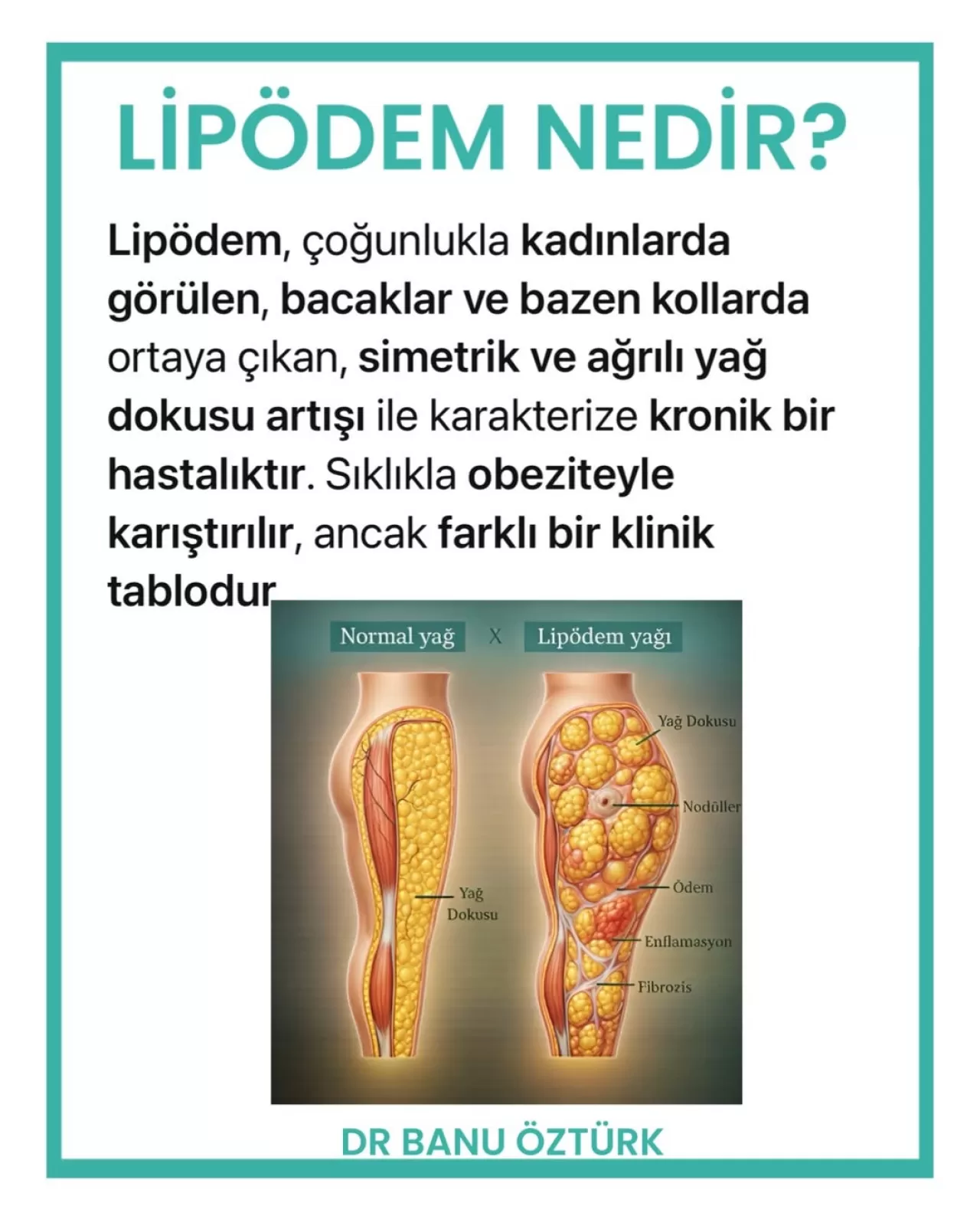 Lipödem Hastalığı ve Güncel Fonksiyonel Tıp Yaklaşımları