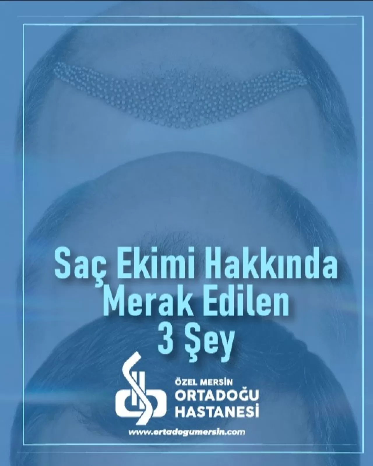 Mersin'de Saç Ekimi Hakkında En Çok Merak Edilen 3 Soru Yanıtlandı