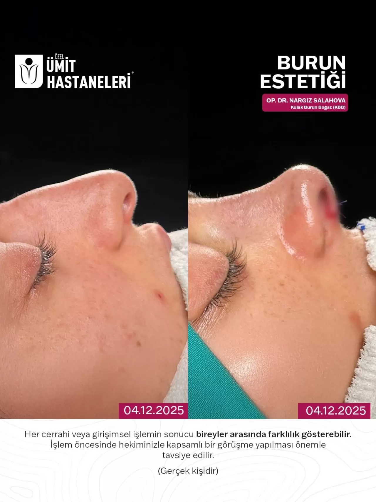 Özel Ümit Hastanesi'nde Kişiye Özel Burun Estetiği Uygulamaları