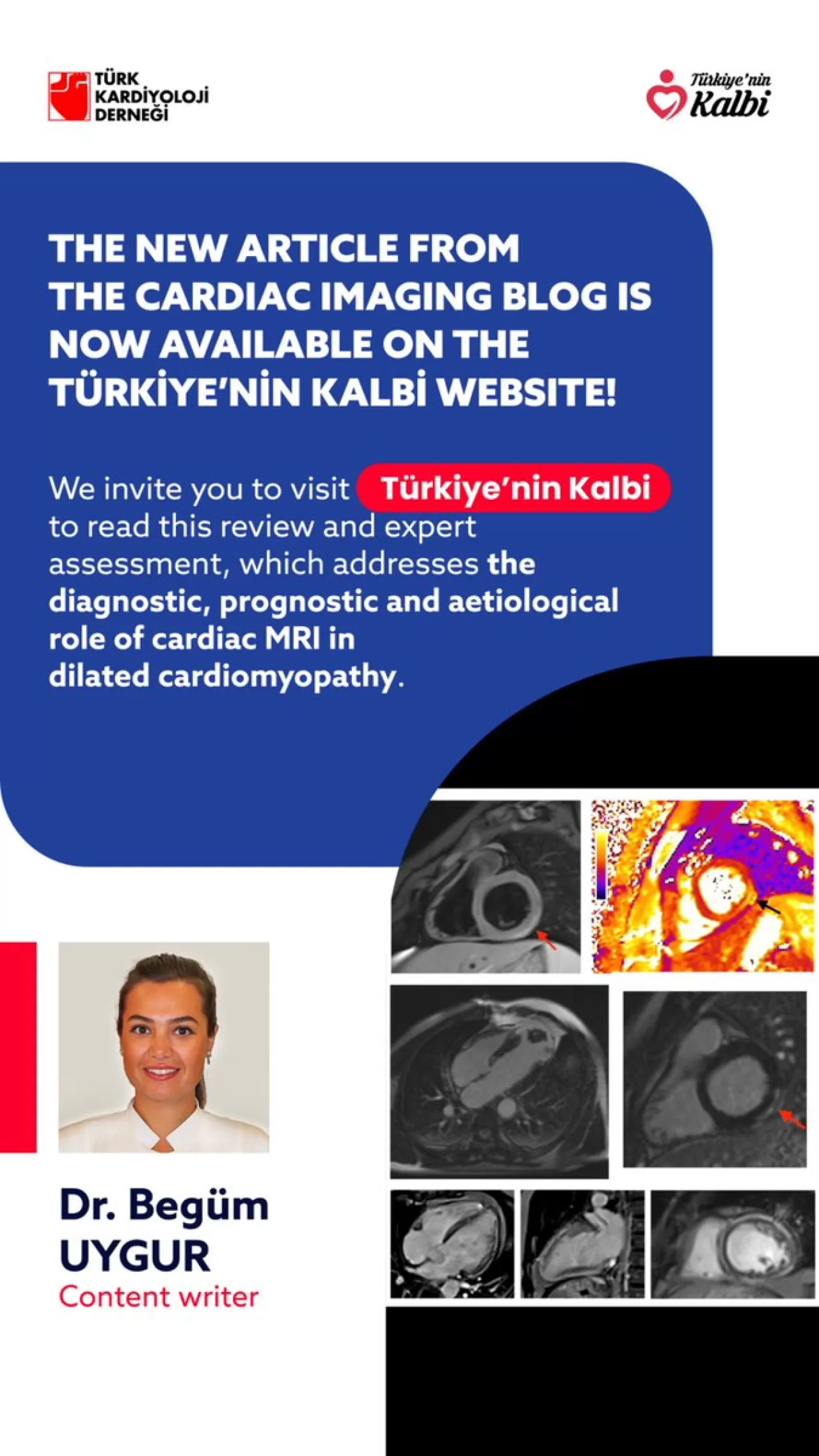 Dilate Kardiyomiyopati Teşhisinde Kalp MR'ının Rolü Masaya Yatırıldı