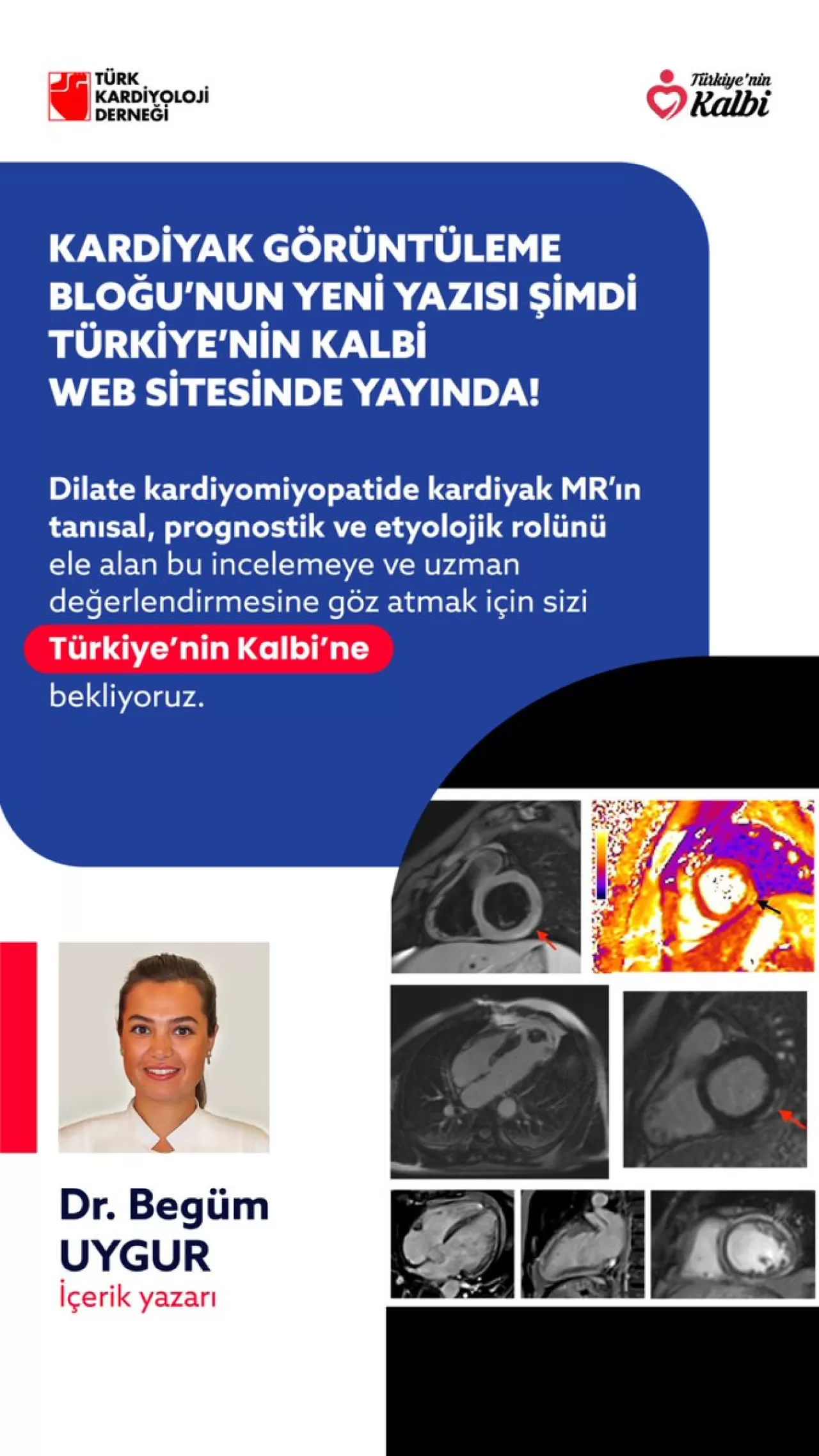 Türk Kardiyoloji Derneği'nden Dilate Kardiyomiyopati Tanısında MR'ın Rolünü Anlatan Önemli Açıklama