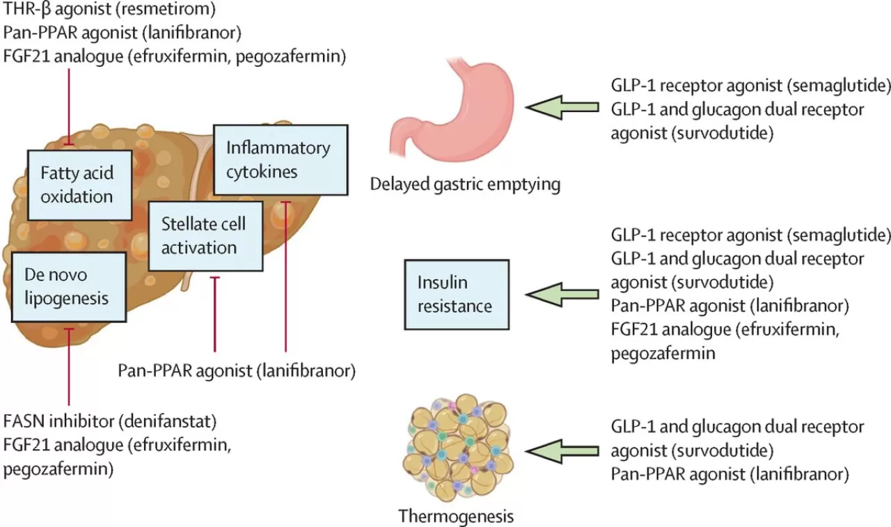 Küresel Çapta En Yaygın Kronik Karaciğer Hastalığı: MASLD