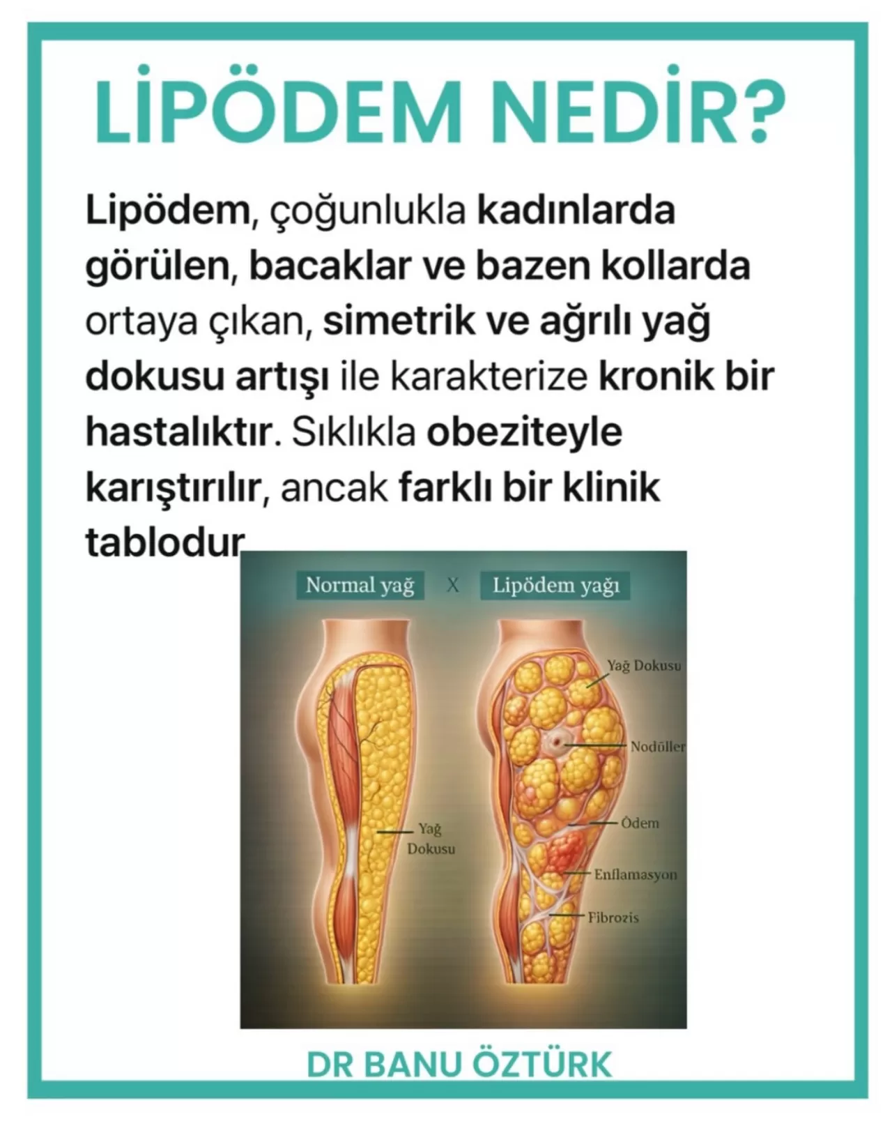 Lipödem Hastalığında Multidisipliner Tedavi Yöntemleri ve Başarı Şansı