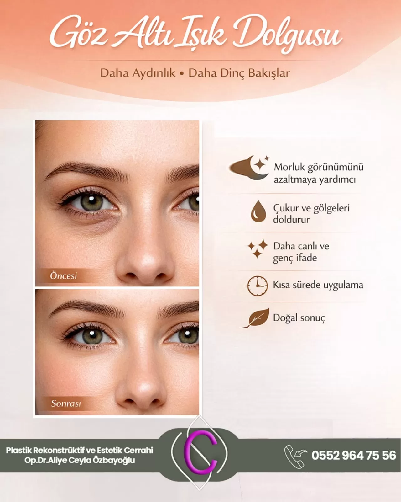 Göz Altındaki Çukur ve Morluklar Işık Dolgusu ile Düzeltilebiliyor