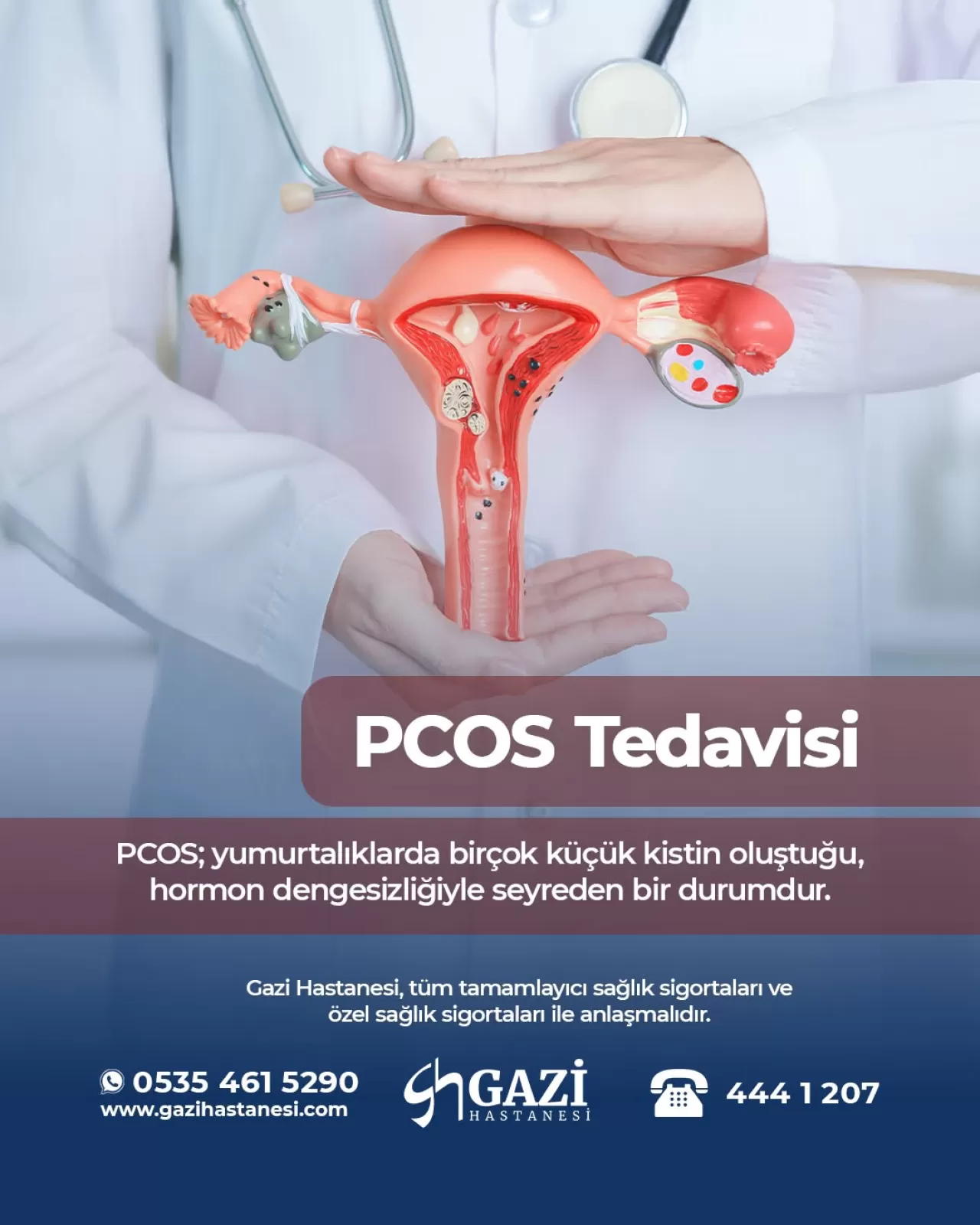 Polikistik Over Sendromu (PCOS) Belirtileri ve Tedavi Yöntemleri