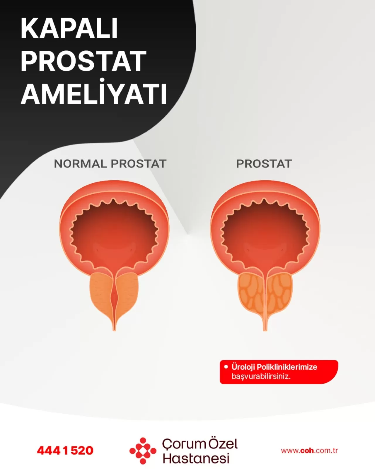 Çorum'da Kapalı Prostat Ameliyatları ile Yaşam Kalitenizi Yükseltin