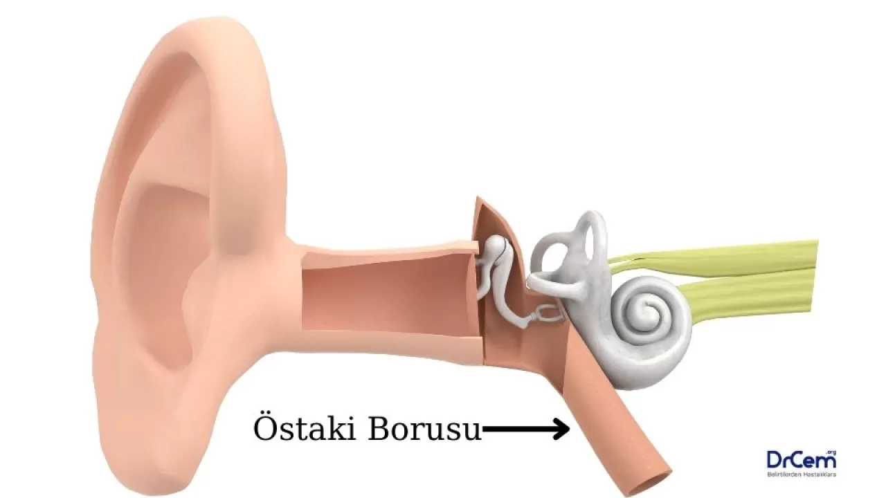 Sessiz Östaki Tüpü Disfonksiyonu: Günlük Kulak Tıkanıklığının Gözden Kaçan Nedeni