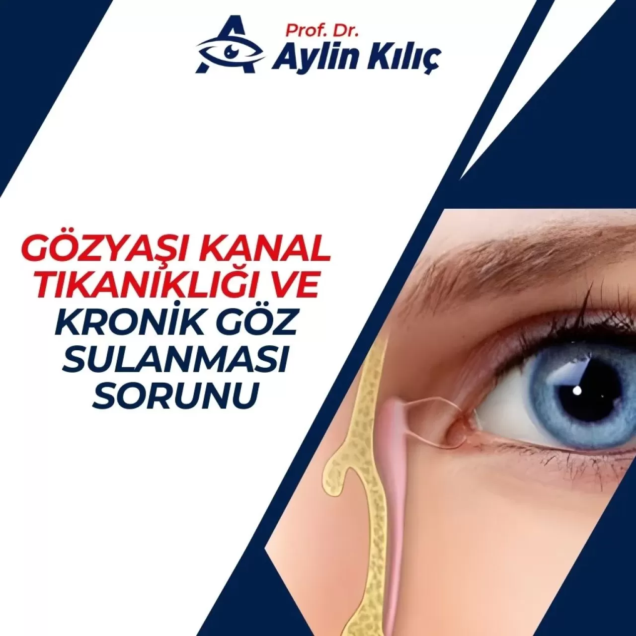 Göz Yaşarması Sanılandan Daha Yaygın Bir Hastalığın İşareti Olabilir