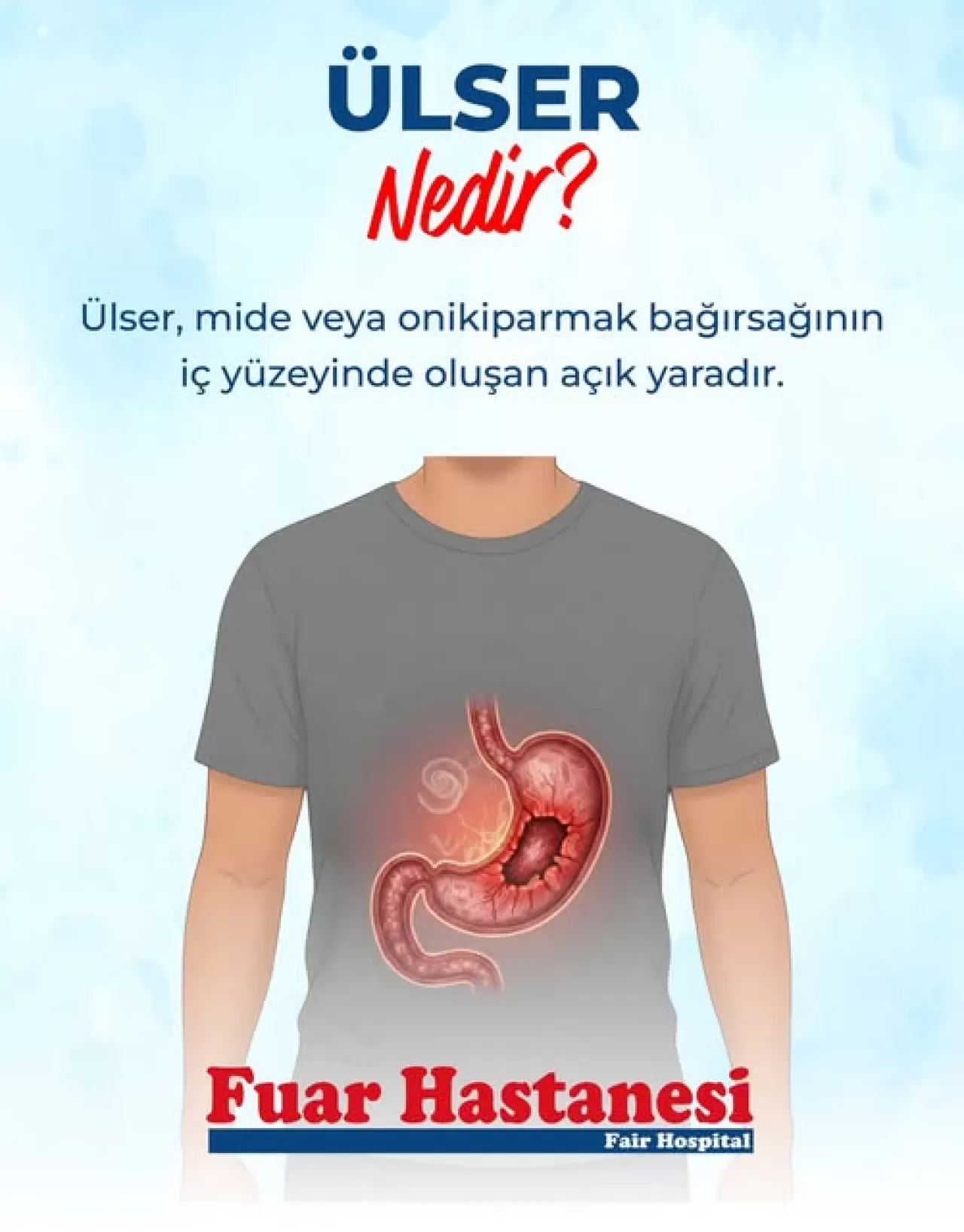 Mide ve Bağırsak Ülseri: Belirtileri, Nedenleri ve Önemi