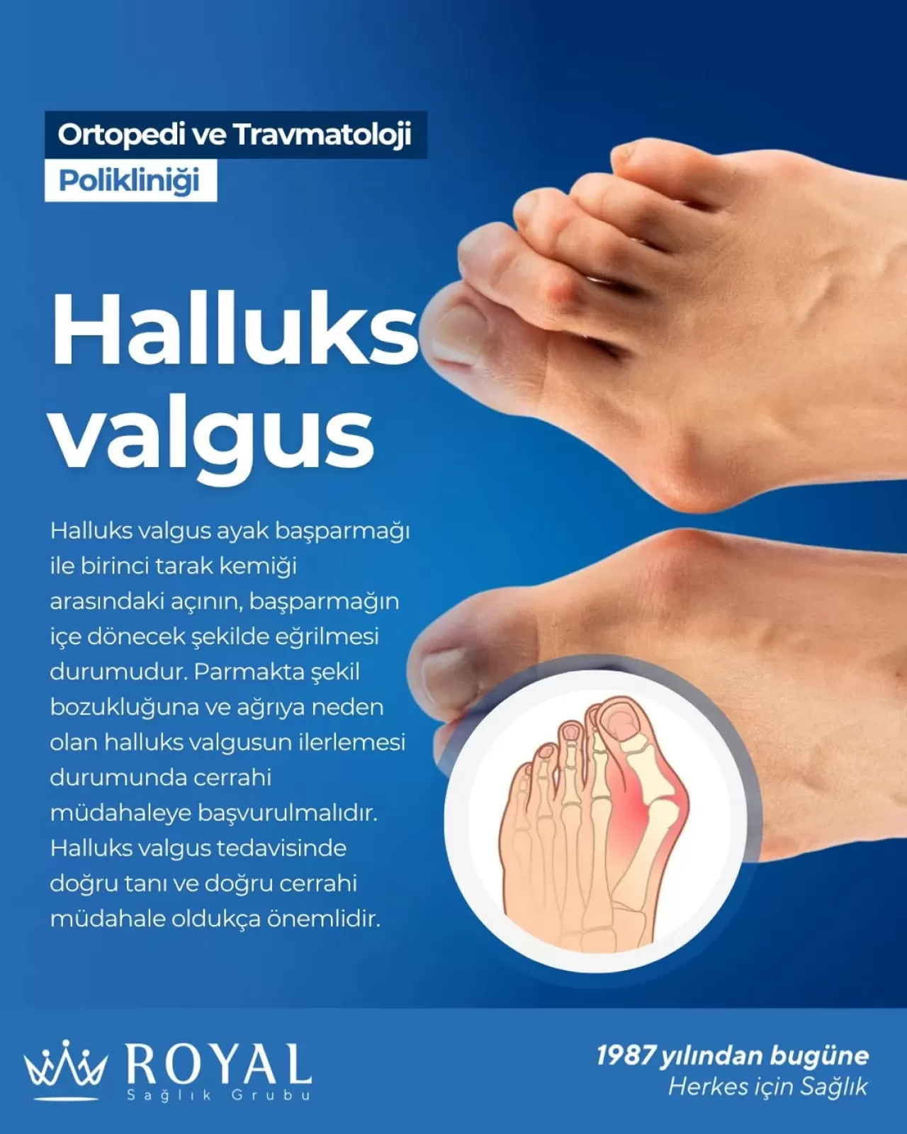 Halluks Valgus Tedavisinde Doğru Tanı ve Cerrahi Müdahalenin Önemi
