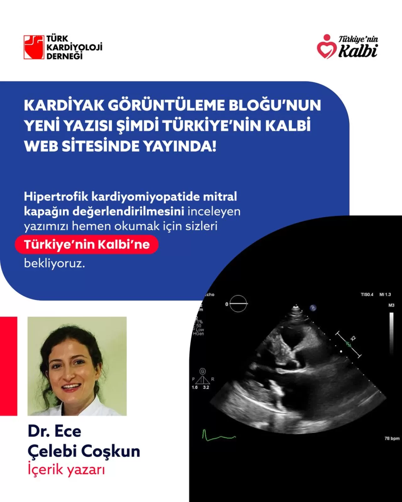 Hipertrofik Kardiyomiyopatide Mitral Kapak Değerlendirmesi Türkiye'nin Kalbi'nde