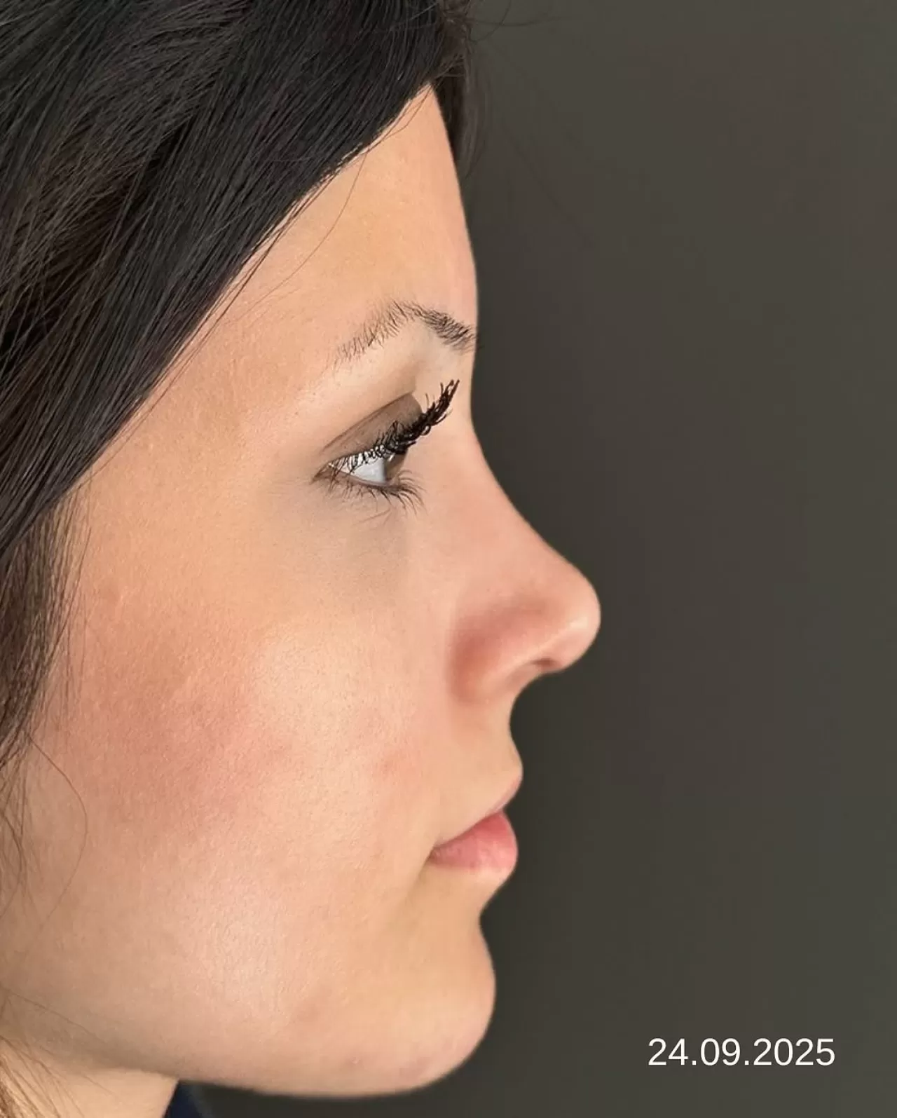 Kapadokya'da Burun Estetiği Ameliyatı Sonrası 3. Ay Kontrolü